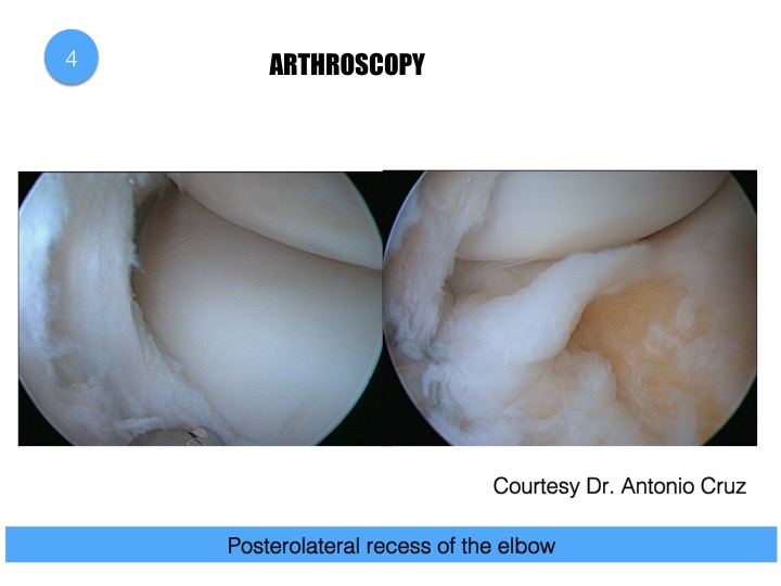 Figure 4 for case Elbow synovial fold syndrome (posterolateral impingement)